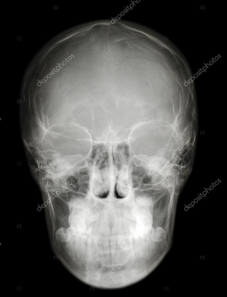  - depositphotos_3245150-X-ray-scull-front-profile