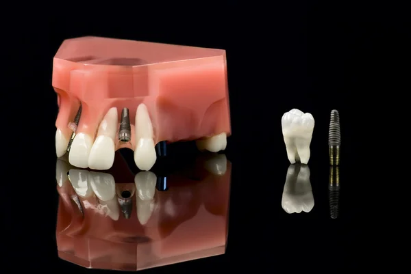 Dental Titanium Implant and Wisdom tooth