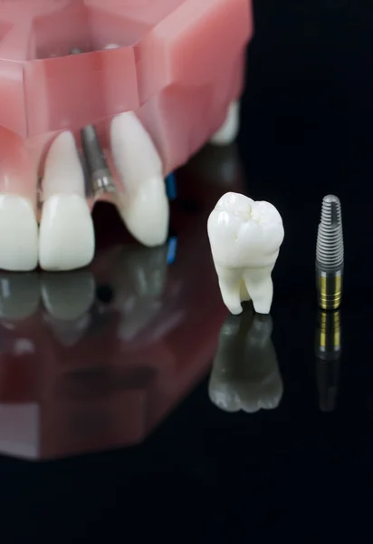 Wisdom tooth, Implant and Teeth Model