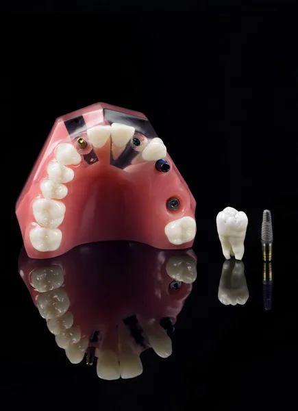 Wisdom tooth, Implant and Teeth Model