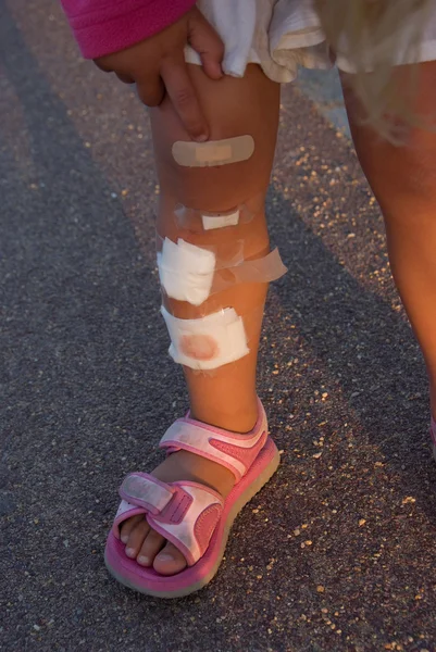 Little girl showing her leg wounds