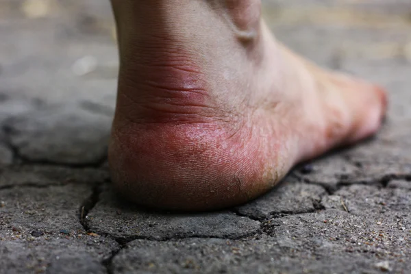 Human foot with cracks