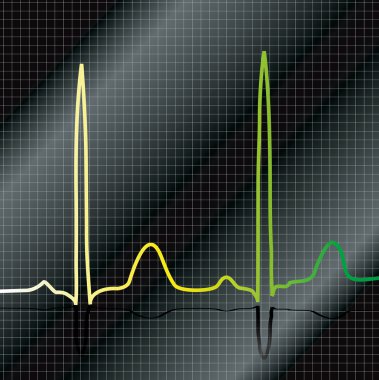 Degrade EKG