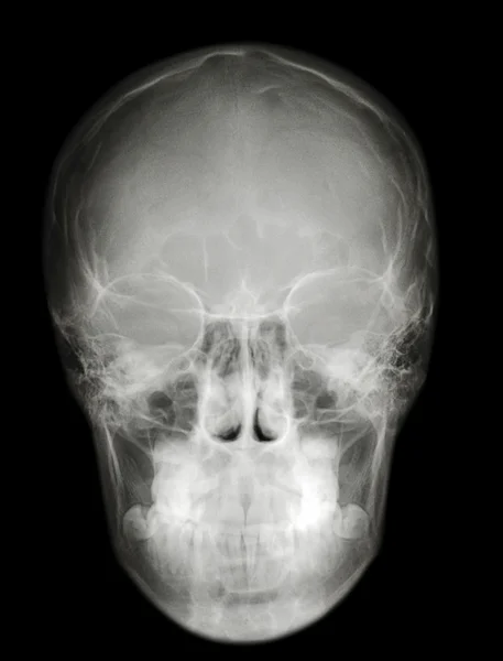 Raio-X scull perfil frontal — Fotografia de Stock