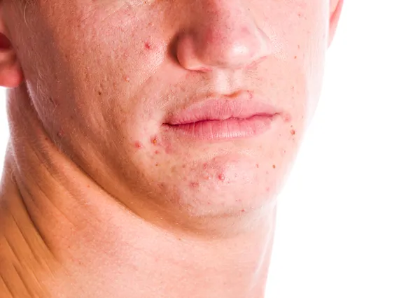 Cara de acne — Fotografia de Stock
