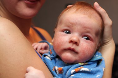 Baby has eczema on his face clipart