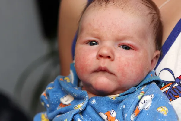 Μωρό με αλλεργική ΔΙΑΘΕΣΗΣ — Φωτογραφία Αρχείου
