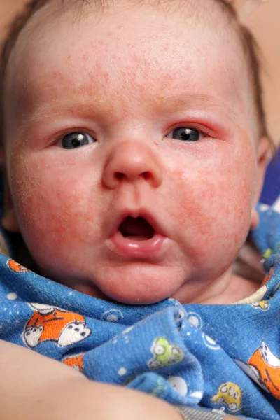 Немовля з алергічним діатезом — стокове фото