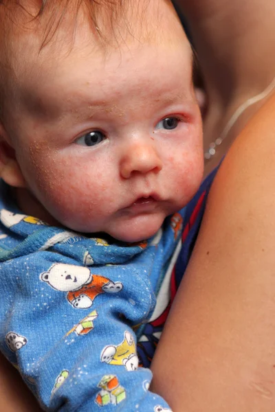 Säugling mit Ekzemen im Gesicht — Stockfoto