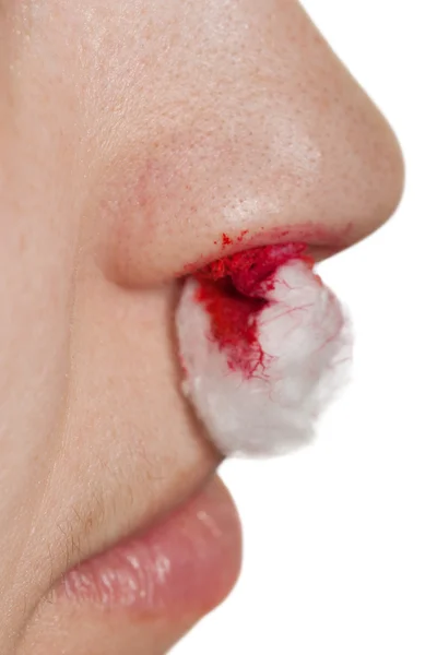 Hemorragia nasal — Fotografia de Stock