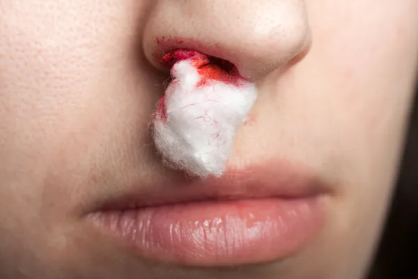 Sanguinamento dal naso — Foto Stock