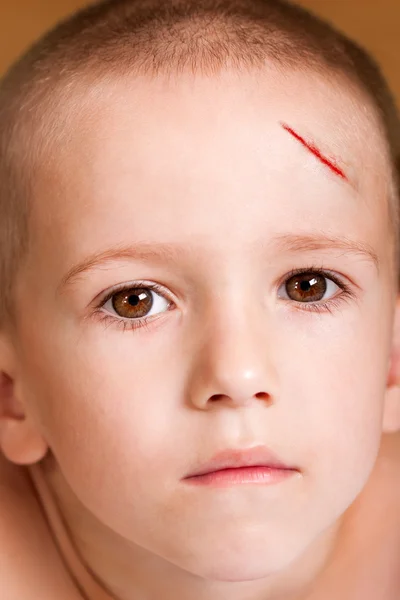 Раненый ребёнок — стоковое фото