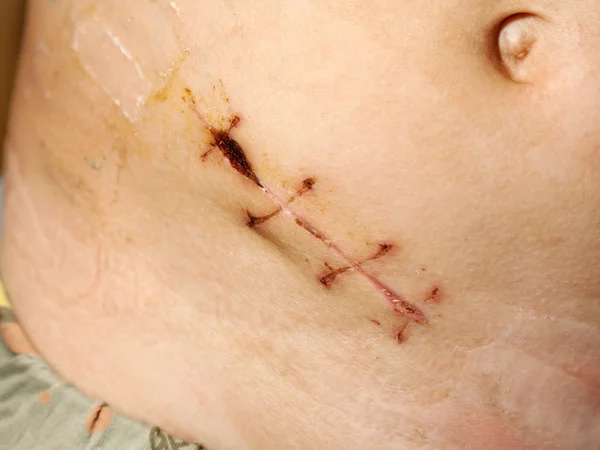 Appendice rimozione sutura chirurgica — Foto Stock