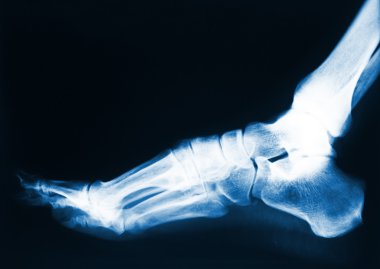 Foot x-ray clipart