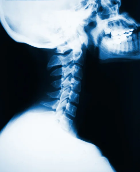 Halsen röntgen — Stockfoto