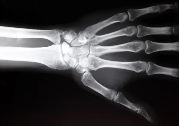 Radiografia della mano — Foto Stock