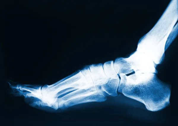 Foten röntgen — Stockfoto