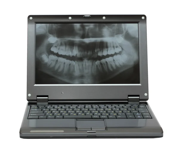 Маленький ноутбук со стоматологической картиной челюсти — стоковое фото