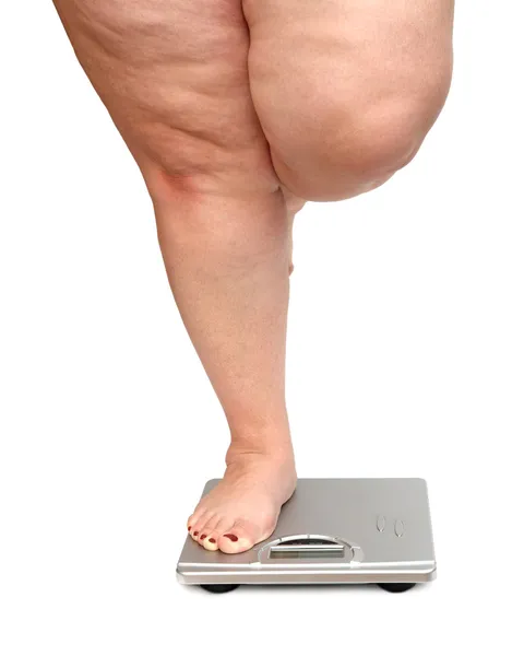 Túlsúlyos nő lába — Stock Fotó