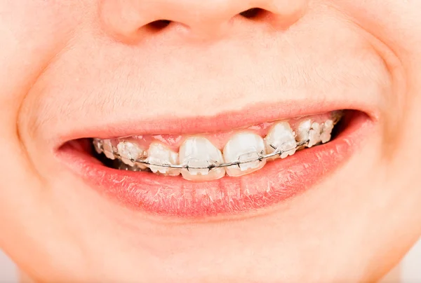 stock image Braces