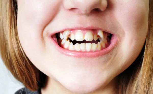 Slechte tanden — Stockfoto