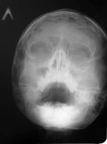Immagine a raggi X della testa dei bambini. Foto Stock Royalty Free