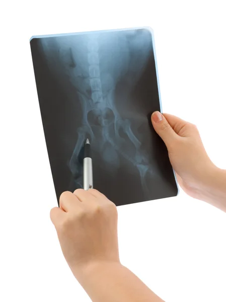 stock image X-ray in hands