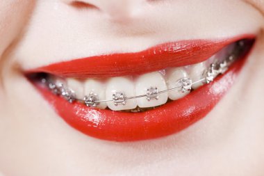 Dental braces clipart