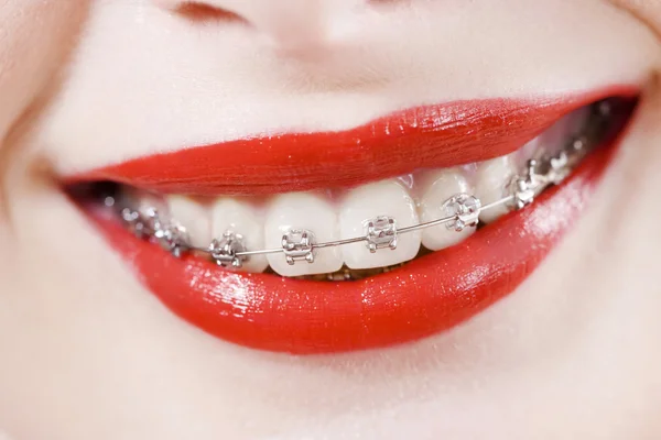 Dental braces — Stock Photo, Image