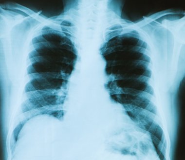 X-ray image of chest bones of adult clipart