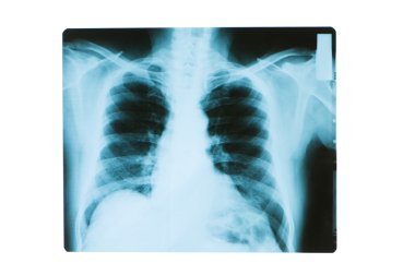 X-ray image of chest bones of adult clipart