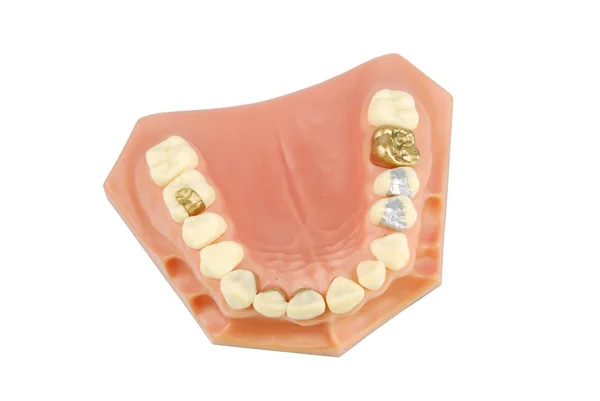 Modelo dentário (com tratamentos diferentes ) — Fotografia de Stock