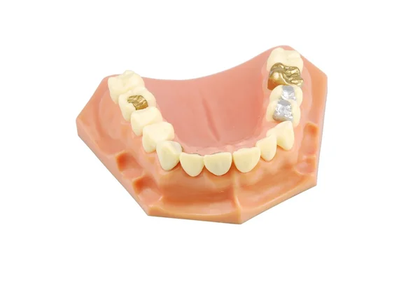 Zahnmodell (mit unterschiedlichen Behandlungen)) — Stockfoto