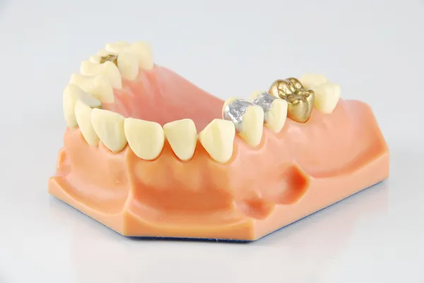Dental model (with different treatments) — Stock Photo, Image