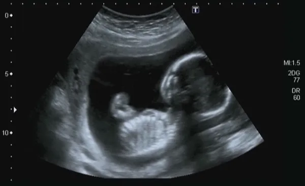 Üç boyutlu ultrason — Stok fotoğraf