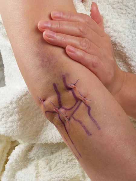 Operação cicatriz. Feminino . — Fotografia de Stock