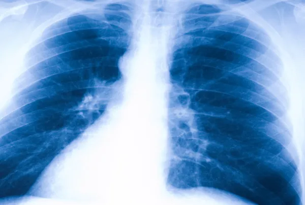 Fotografia de raios-X de pulmões humanos — Fotografia de Stock
