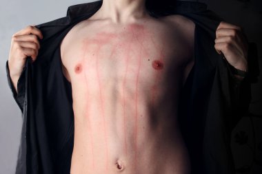 Young man covered with scars clipart