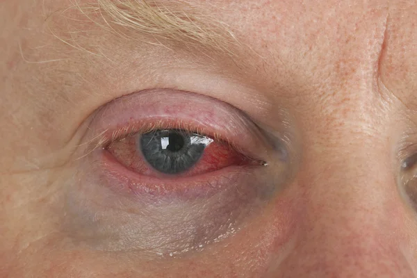 Kanlı göz — Stok fotoğraf