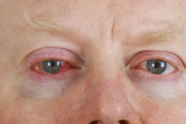 Кровавый глаз — стоковое фото