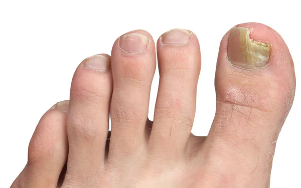 Unghie dei piedi Fngus a picco infezione Fotografia Stock