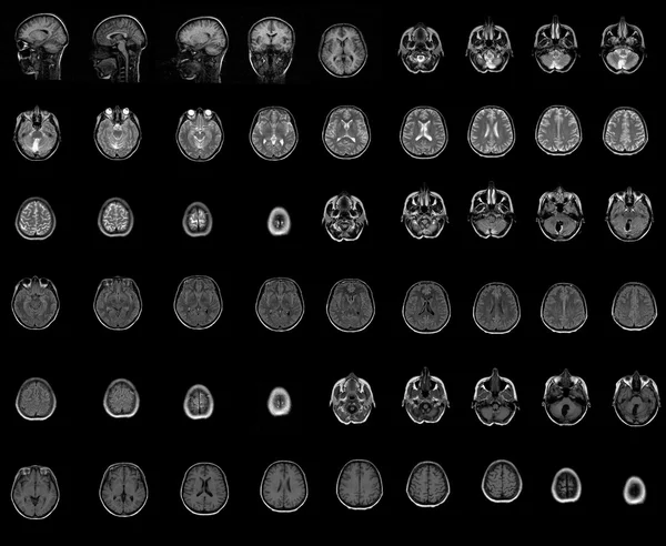 Tomografia computerizzata del cervello — Foto Stock