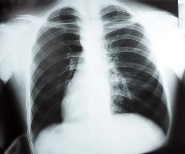 Рентген грудной клетки на просмотрщике — стоковое фото