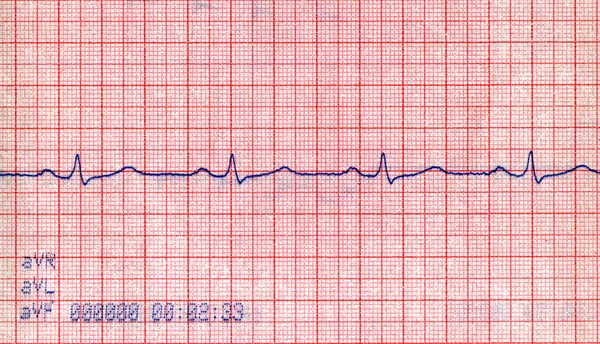 Closeup cardiovascular doppler diagram, pacient stress concept — Stock Photo, Image