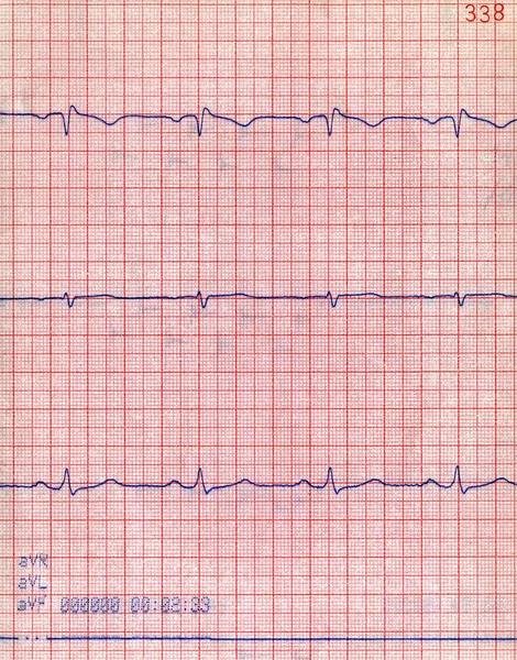 Diagrama de ritmo cardíaco macro, conceito de estresse paciente — Fotografia de Stock