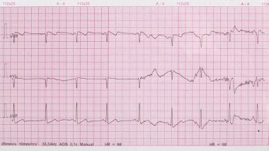 EKG Yazdır