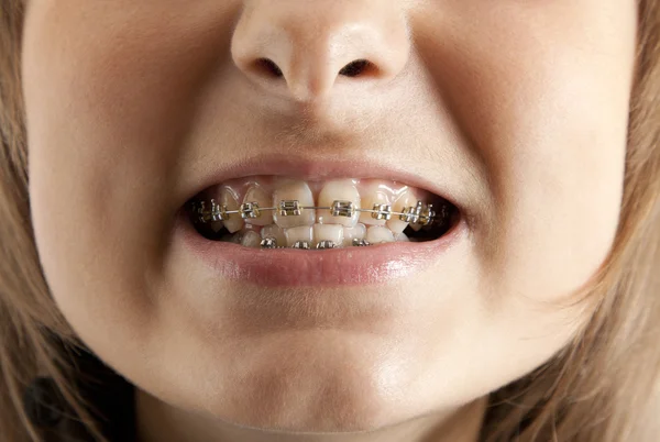 Menina sorri com suporte nos dentes — Fotografia de Stock