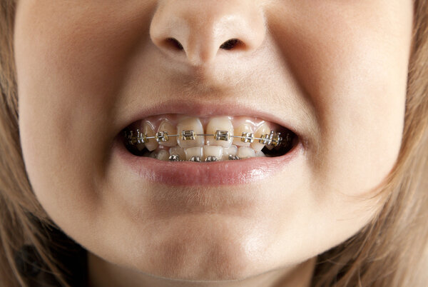 Girl smiles with bracket on teeth