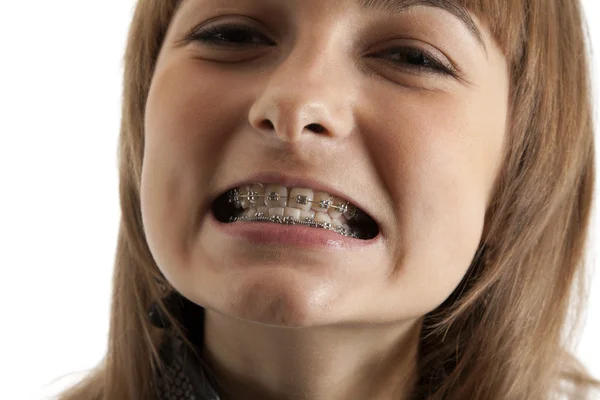Дівчина посміхається з кронштейном на зубах — стокове фото