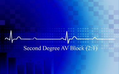 Second degree AV block in coronary disea clipart